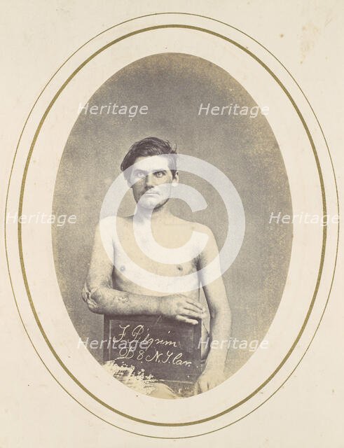 Frederick Pilgrim, 1865. Creator: Reed Brockway Bontecou.