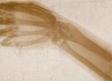 The bones of a hand and wrist, viewed through x-ray, 1896.