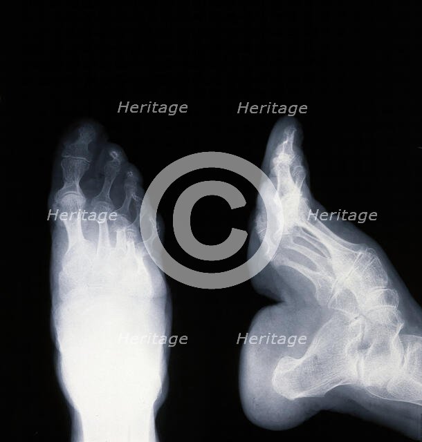 A deformed foot: X-ray, 20th century. Creator: Unknown.