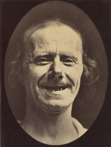 Figure 52: Voluntary retraction of the lower lip, 1854-56, printed 1862. Creators: Duchenne de Boulogne, Adrien Alban Tournachon.