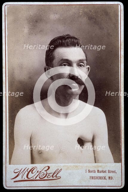 Reverend Eavens, a man with a hole in his chest, between 1800 and 1899. Creator: WC Bell.