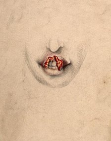 Severely diseased tissue on the upper lip of a woman suffering from tertiary syphilis, 1869. Creator: Christopher D'Alton.
