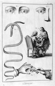 Eye surgery, 1751-1777. Artist: Unknown