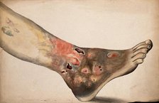 A diseased foot and lower leg. Creator: Unknown.