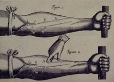 Two arms, and a finger pointing towards a vein, 1628. Creator: Unknown.