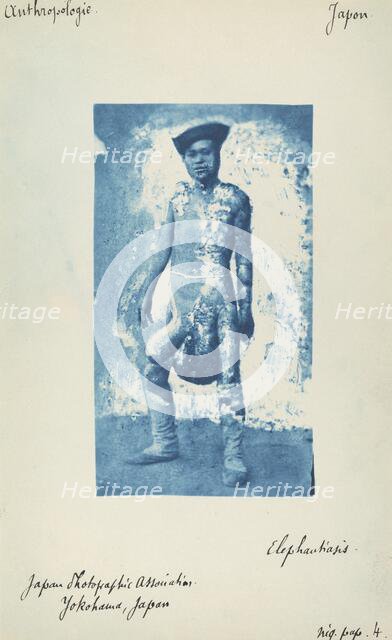 Elephantiasis, c. 1870s. Creator: Unknown.