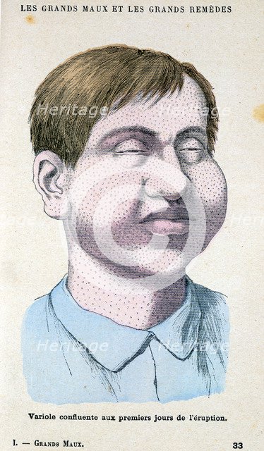 Smallpox victim, c1890. Artist: Unknown