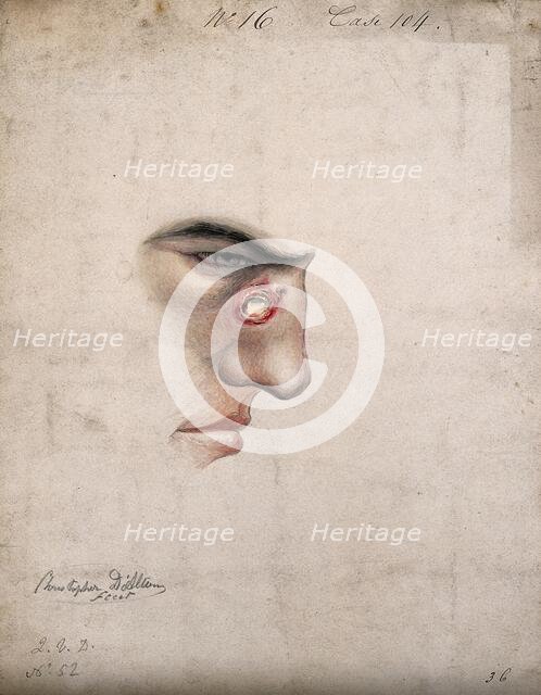 A detail of a man's face seen in profile with a severe disease affecting his nose, 1856. Creator: Christopher D'Alton.