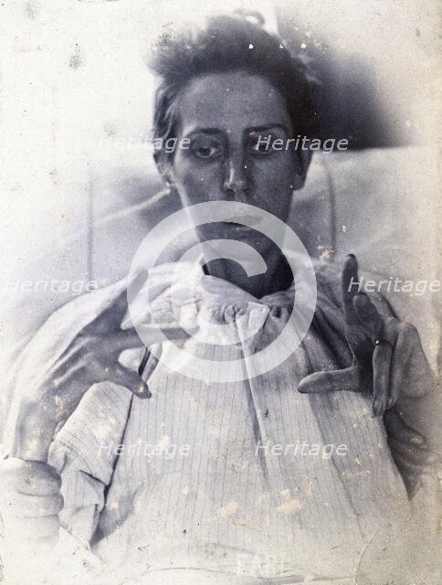 Friern Hospital, London: a woman suffering from mania, with forearm, hand and finger..., 1890/1910. Creator: Unknown.