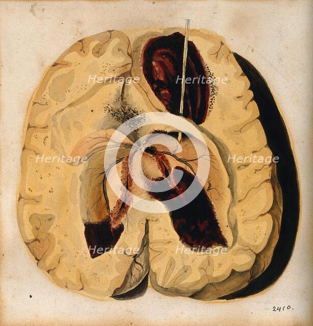 A diseased brain, 1800-1850. Creator: Richard Bright.