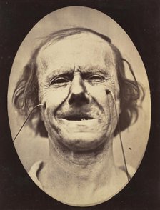 Figure 48: Mild weeping, pity and feeble false laughter , 1854-56, printed 1862. Creators: Duchenne de Boulogne, Adrien Alban Tournachon.
