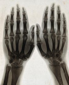 Two hands, viewed through x-ray, 1896.