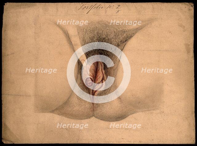 Female genitalia held open by a finger to show an area of diseased tissue, (18)66. Creator: Christopher D'Alton.
