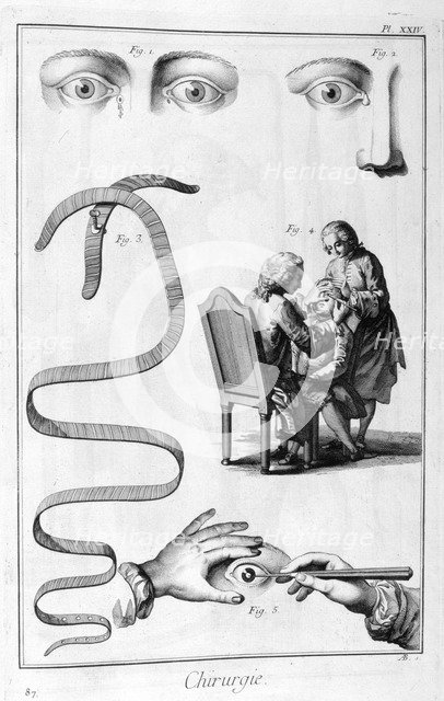 Eye surgery, 1751-1777. Artist: Unknown