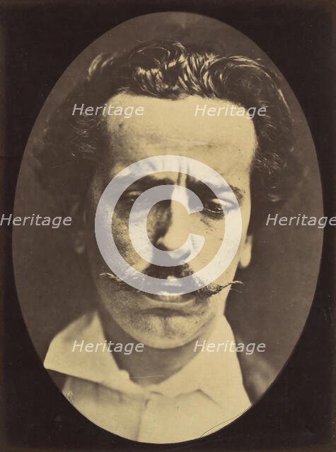 Figure 15: Meditation, mental concentration, 1854-56, printed 1862. Creators: Duchenne de Boulogne, Adrien Alban Tournachon.