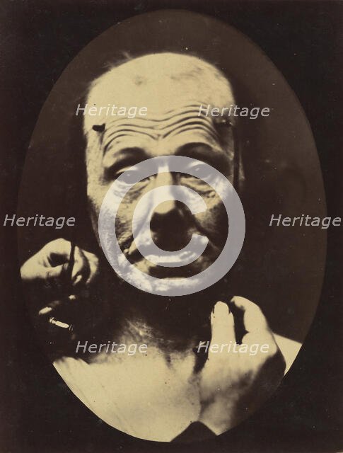 Figure 8: Contraction of the right m. frontalis. , 1854-56, printed 1862. Creators: Duchenne de Boulogne, Adrien Alban Tournachon.