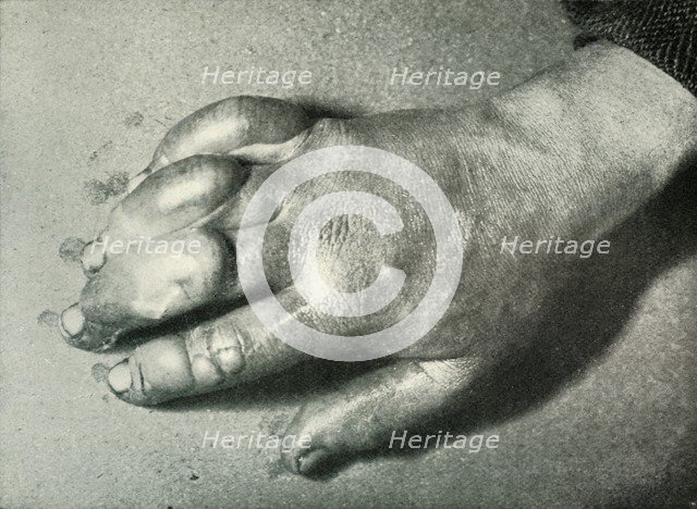 'Dr. Atkinson's Frost-Bitten Hand', 5 July 1911, (1913). Artist: Herbert Ponting.