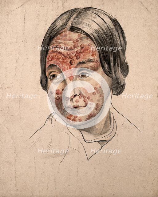 Head of a woman with a severe disease affecting her face, (18)58. Creator: Christopher D'Alton.