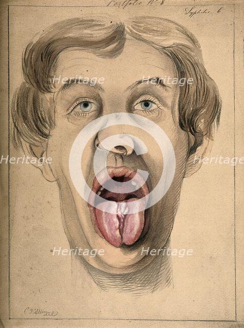 The face of a man suffering from syphilis, shown with mouth open wide, displaying areas of..., 1869. Creator: Christopher D'Alton.