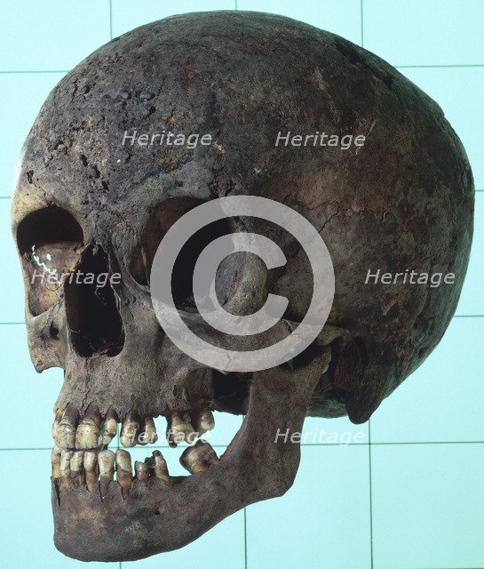 Female syphilitic skull with multiple erosive lesions. Artist: Unknown