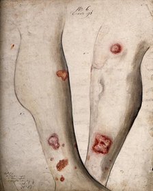 Sores and areas of diseased skin on the lower legs of a boy, between 1800 and 1899. Creator: Christopher D'Alton.