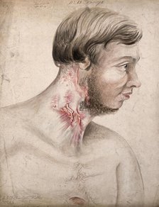 Head and chest of a man with a disease affecting his neck, seen in profile, 1856. Creator: Christopher D'Alton.