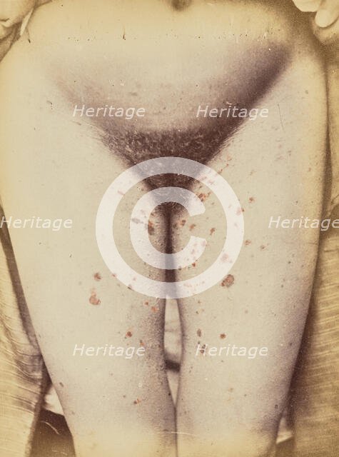 Syphilide, 1871. Creator: Arthur de Montmeja.