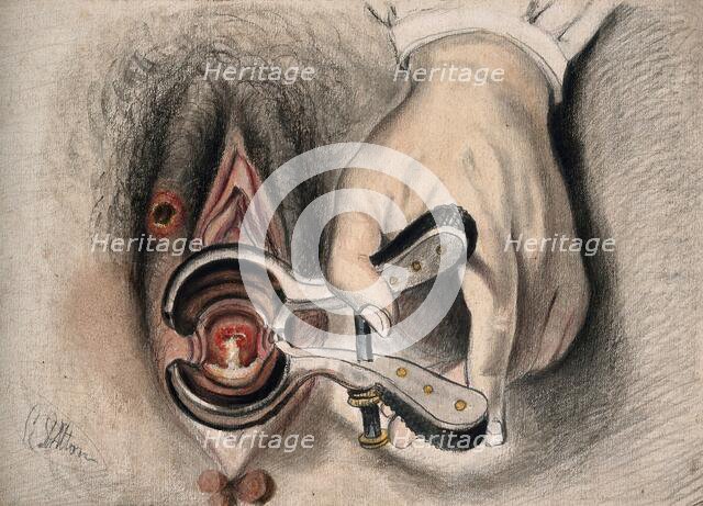An infected sore on the female genitalia shown with the aid of a vaginal speculum, 1800-1899. Creator: Christopher D'Alton.