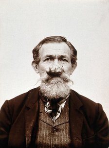 A patient of Léon Desguin, before operation, c1890s. Creator: Unknown.