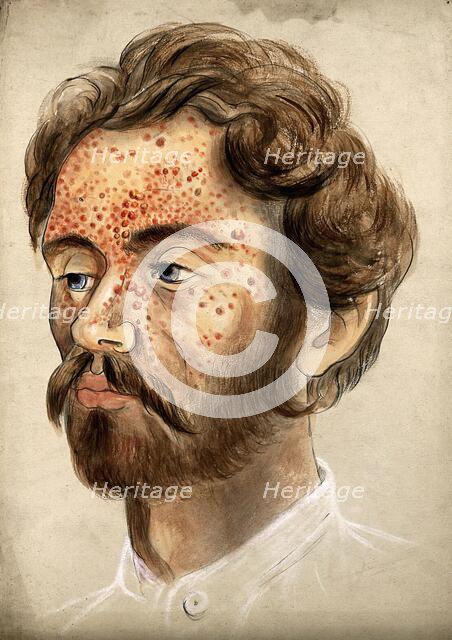Head of a man with a severe disease affecting his face, (18)60. Creator: Christopher D'Alton.