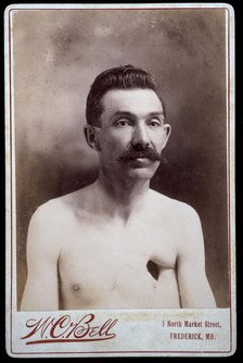 Reverend Eavens, a man with a hole in his chest, between 1800 and 1899. Creator: WC Bell.