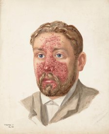 The head of a man with skin disease, July 1889. Creator: W Toogood Hill.