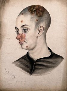 Head of a young woman with a severe disease affecting her face and scalp, (18)58. Creator: Christopher D'Alton.