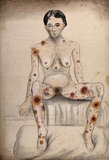 A seated woman displaying areas of diseased tissue on her entire body, face, genitals and eye, 1858. Creator: Christopher D'Alton.