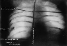 X-Ray of Roosevelt [shows bullet], 1912. Creator: Bain News Service.