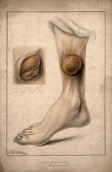 Tertiary tubercular elephantiasis on the thigh and calf of a woman, 1874. Creator: Christopher D'Alton.
