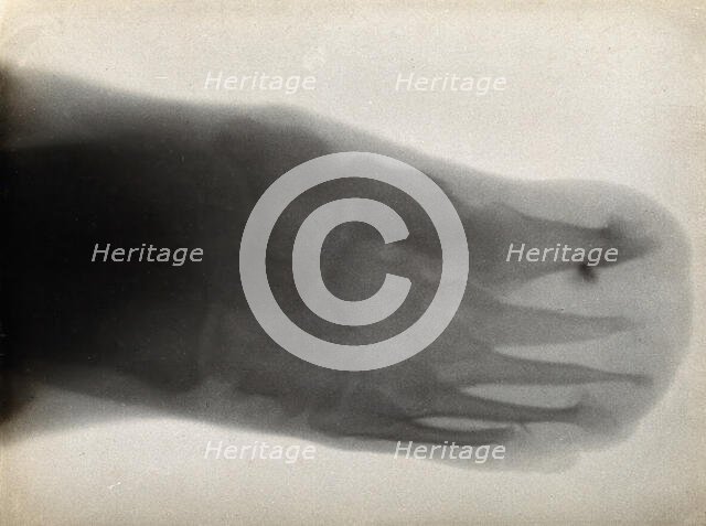 The bones of a foot, possibly with leprosy, viewed through x-ray, 1896.