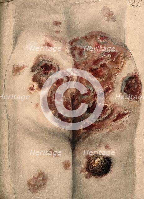 Severely diseased tissue on the buttocks and thighs of a man, 1867. Creator: Christopher D'Alton.