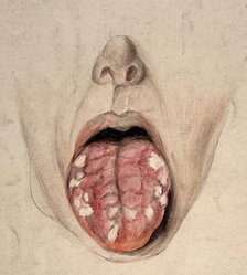 Diseased tissue on the tongue of a man suffering from syphilis, (18)57. Creator: Christopher D'Alton.