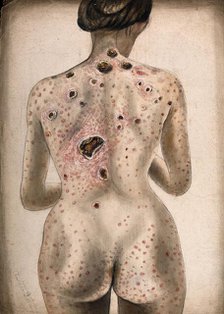 The back, buttocks and arms of a woman, displaying areas of diseased tissue..., (1840/1870?). Creator: Christopher D'Alton.