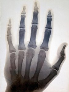 Sir Gervas Powell Glyn, 6th Bart: radiograph of his hand, 1896. Creator: Sir GP Glyn.