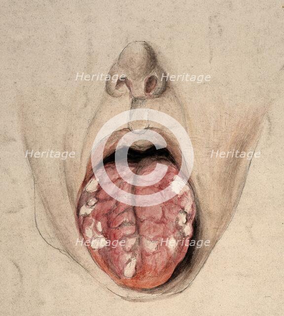 Diseased tissue on the tongue of a man suffering from syphilis, (18)57. Creator: Christopher D'Alton.