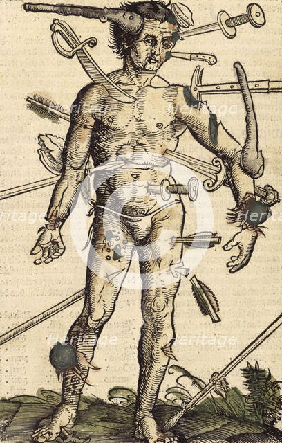 The wound man, 1517.  Creator: Hans Wechtlin the Elder.
