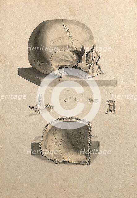 Human skull: six figures showing sections and an entire skull, 1830-1835. Creator: Unknown.