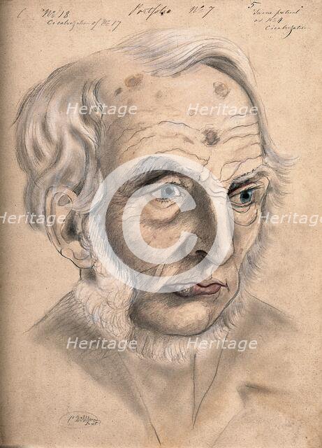 A man suffering from chancre of the lip, displaying scar tissue on his lower lip, forehead..., 1867. Creator: Christopher D'Alton.