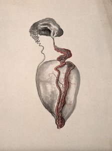 A diseased part of the body. Creator: Unknown.