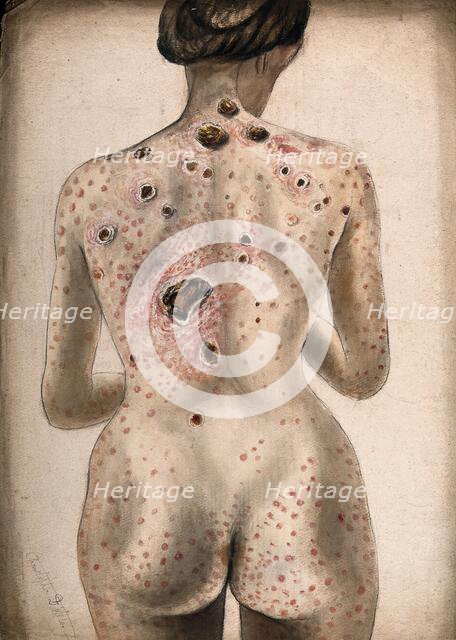The back, buttocks and arms of a woman, displaying areas of diseased tissue..., (1840/1870?). Creator: Christopher D'Alton.