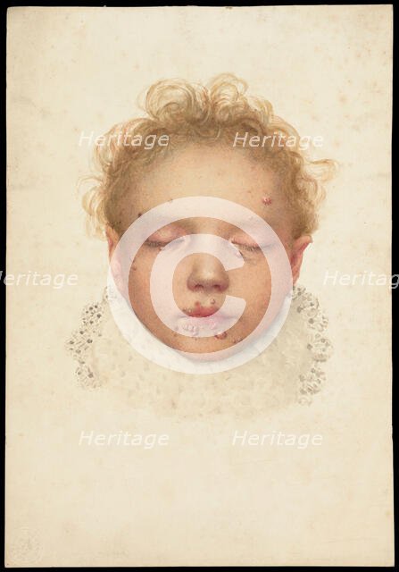 Head of a child with closed eyes and skin disease on the face, 1892. Creator: Unknown.