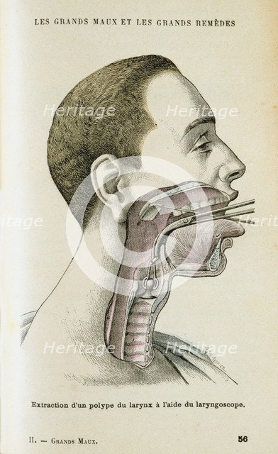 Using a laryngoscope to aid the removal of a polyp from the throat, c1890. Artist: Unknown