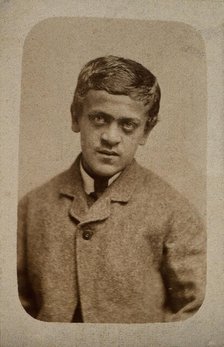 A young man, probably showing some signs of Down's syndrome, c1880s. Creator: Davis & Sons.